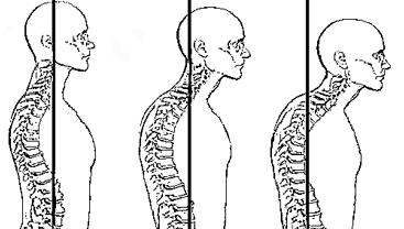 Getting anterior head carriage or forward head posture is not an overnight process. It can take years and is very gradual.