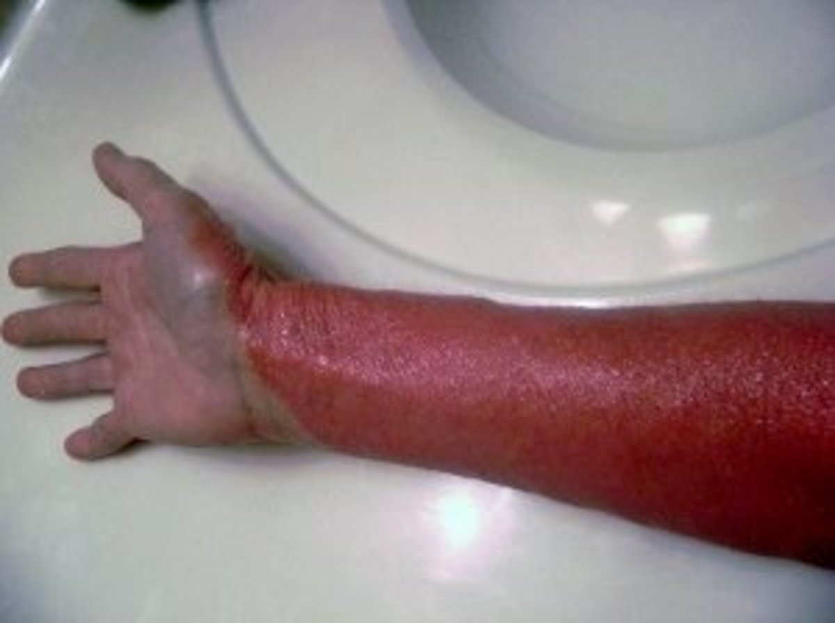 Red skin syndrome steroid