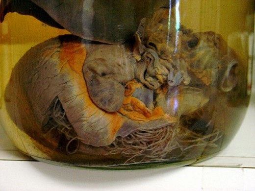 Cross-section of diseased canine heart showing heartworm infestation. 