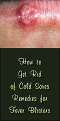 How to Get Rid of a Fever Blister Fast  HealDove