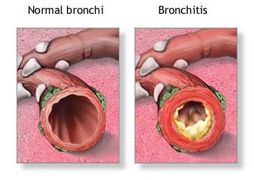 Clogging of the bronchi 