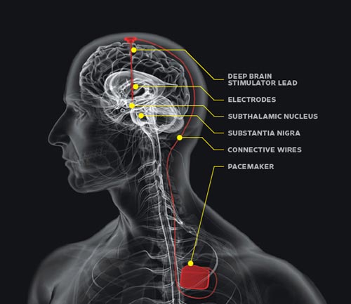 neurological pacemaker