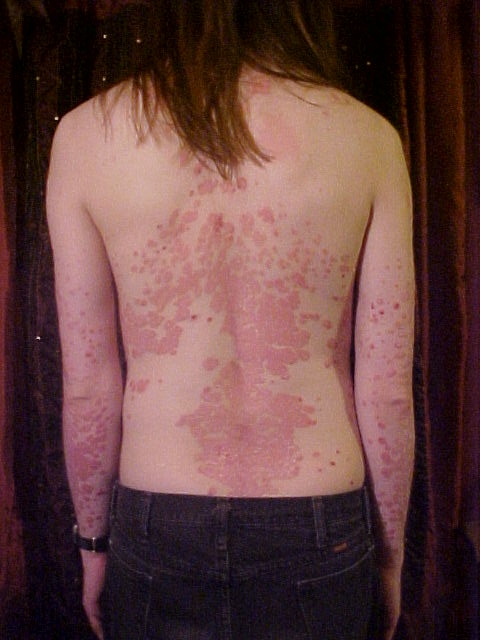 A young man affected by psoriasis
