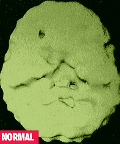 Image from a SPECT scan of a healthy normal brain, approached as if through the upper mouth. SPECT scanning shows brain activity by detecting blood flow. The large smooth surface show a good blood supply to the brain.