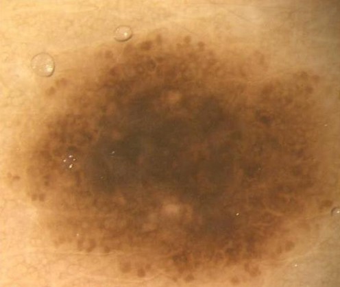 Closeup of hyperpigmentation