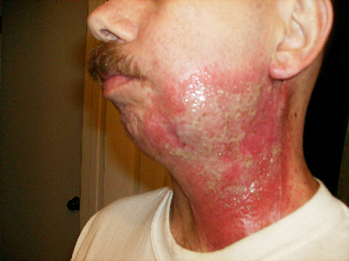 2nd & 3rd Degree burns after a 'boost' of radiation therapy.