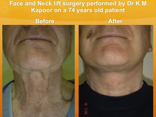 Face- and neck- lift surgery, before and after