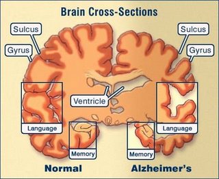 Diagram of brain damage