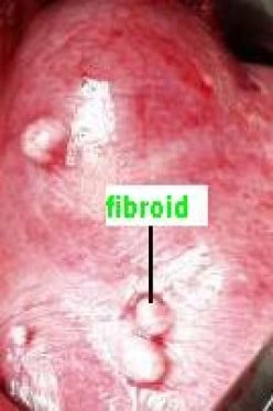 Managing Uterine Fibroids