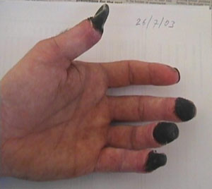 A lot of people with hypothermia obviously have frostbite.  Taken from alanarnette.com