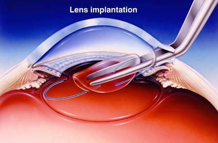 Lens Implantation