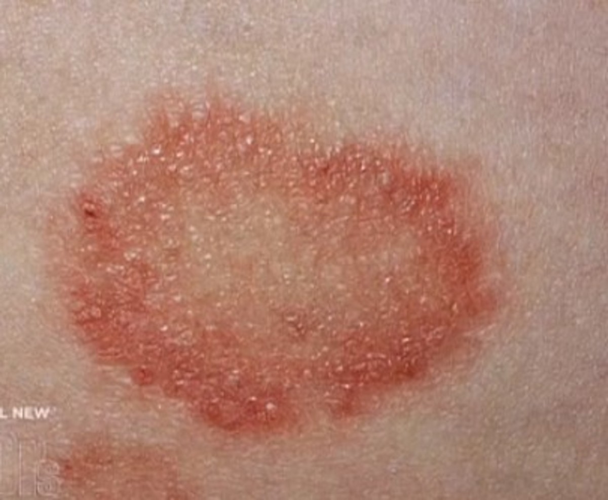 how to get rid of ringworm on the skin