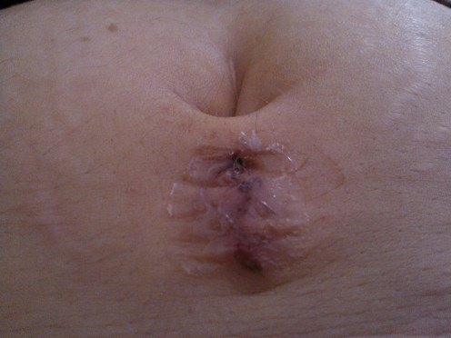 One of four small incisions made in the author's abdomen for Da Vinci Robot assisted hysterectomy.  Note the small scar inside the belly button from a previous laparascopic surgery.