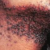 Razor bumps may appear as  tiny black and red projections on the skin that has been shaved.