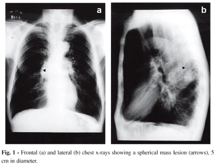 Frontal and lateral view of chest x-rays with a mass lesion (arrows). Case Study: Are You Afraid of Superbugs?