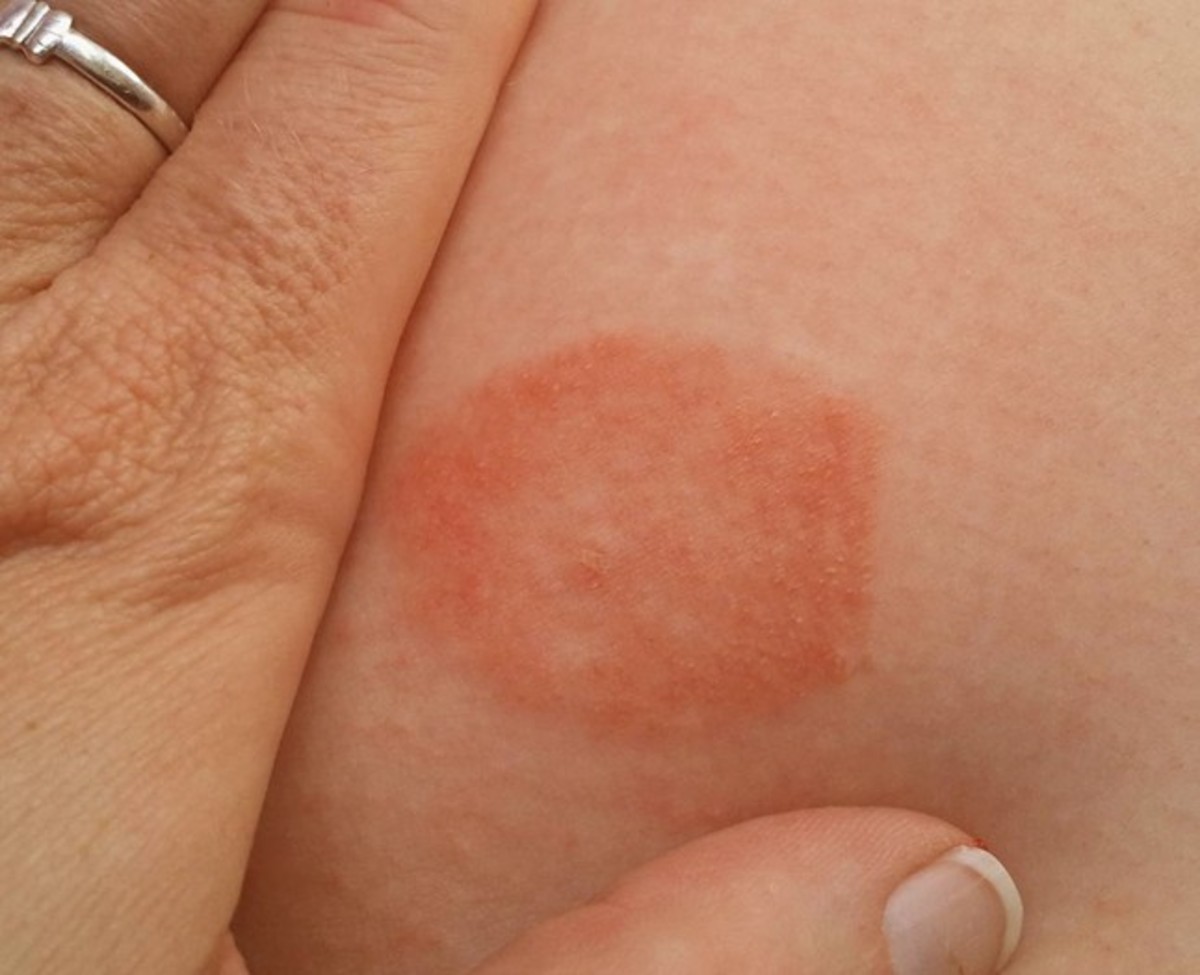 Red Raised Rash On Face - Doctor answers on HealthTap