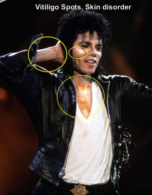 Michael Jackson with possible vitiligo pointed out on his skin.