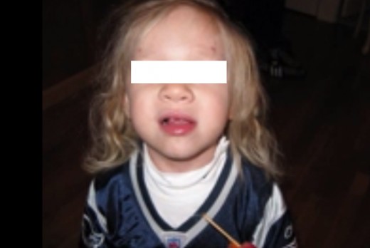 Morquio Syndrome Facts, Symptoms, Treatment, Pictures