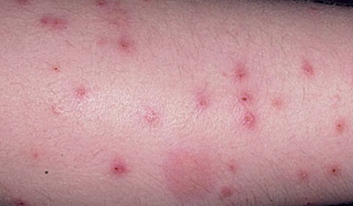 Flea Bites on Humans Symptoms, Treatment, Pictures hubpages