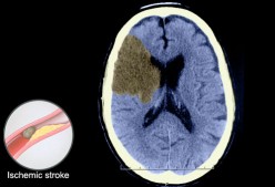 Ischemic stroke
