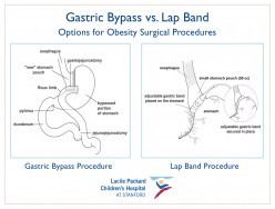 Bariatric Weight Loss Surgery - What Questions Should You Ask the Surgeon?