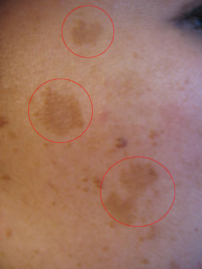 Moles and skin changes can happen for all types of reasons.
