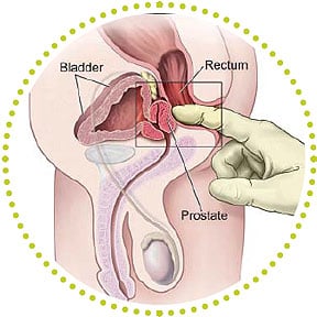 The gloved finger is positioned in the rectum in this way to demonstrate how a doctor would perform a prostate exam on a patient. 