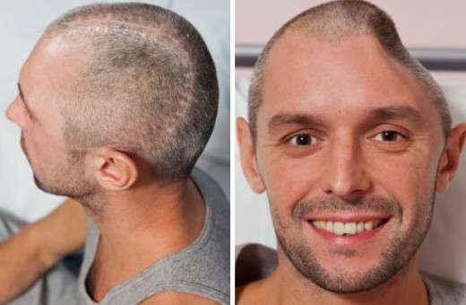 Head trauma before and after missing bone replacement