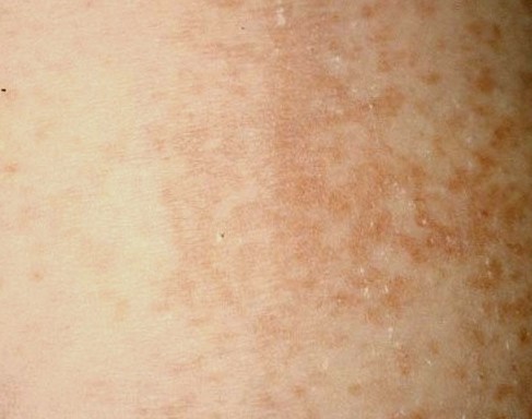 Maculopapular rash – Symptoms, Treatment, Causes, Pictures | HubPages