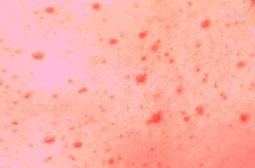 Maculopapular Rash On Face