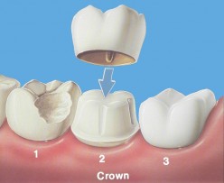 About Dental Crowns