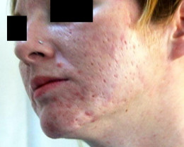 Cystic Acne Cause