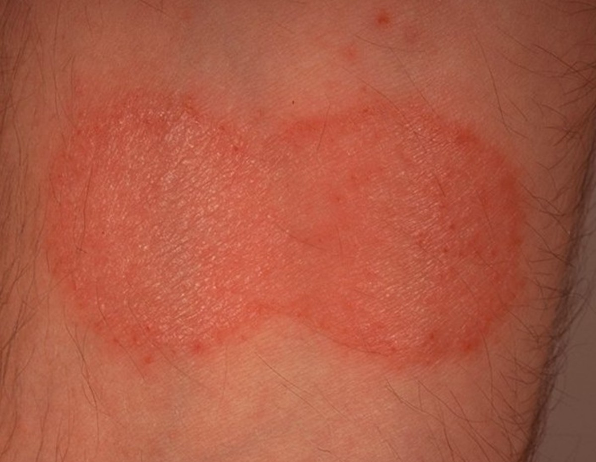 Mycosis Fungoides - Pictures, Staging, Symptoms, Treatment and Causes