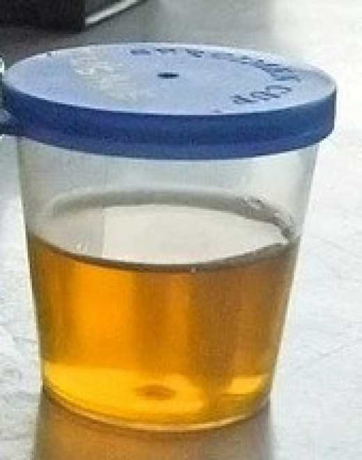 Dark Yellow Urine Hubpages 