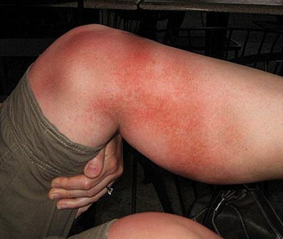 What is heat rash?