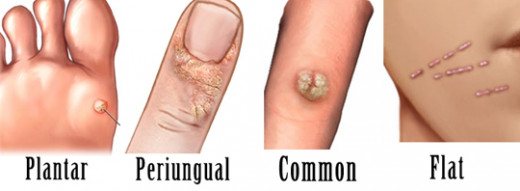 When they grow on different parts of the body, warts are likely to follow typical shape and size patterns, resulting in the above classifications.