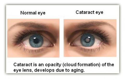 Cataracts Pictures Symptoms Causes Diagnosis Treatment Surgery 