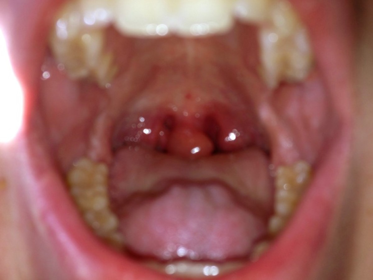 Throat Swollen Uvula 6