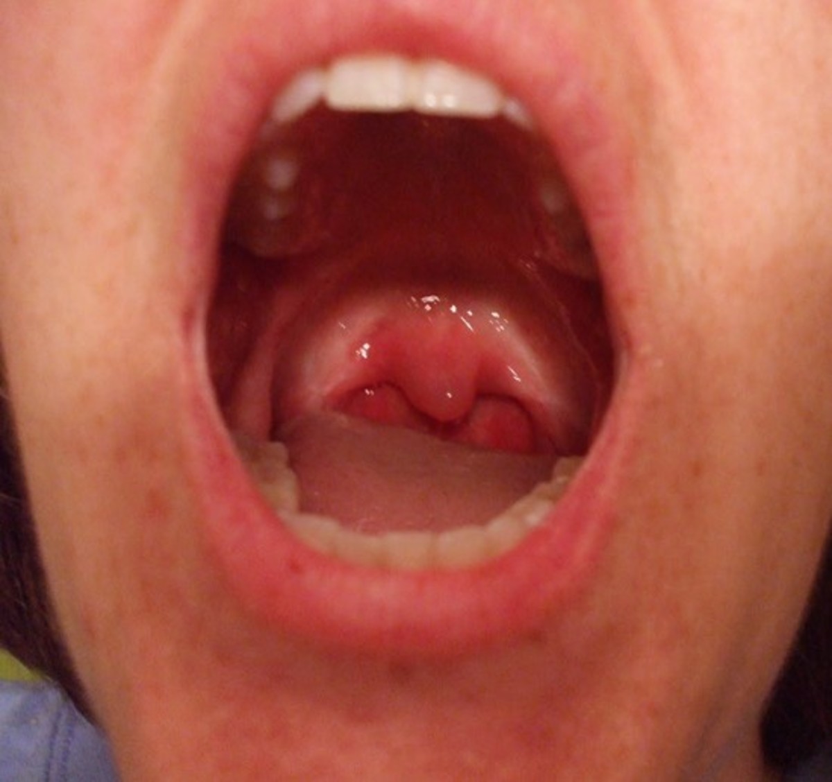 Swelling Of Throat 13