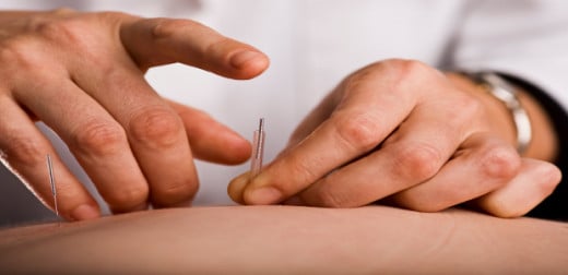Acupuncture and Fibromyalgia 