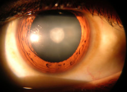 Quick and Easy Way to Improve Your Eyesight:  Cataract Surgery