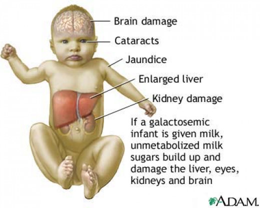 maple syrup urine disease case study