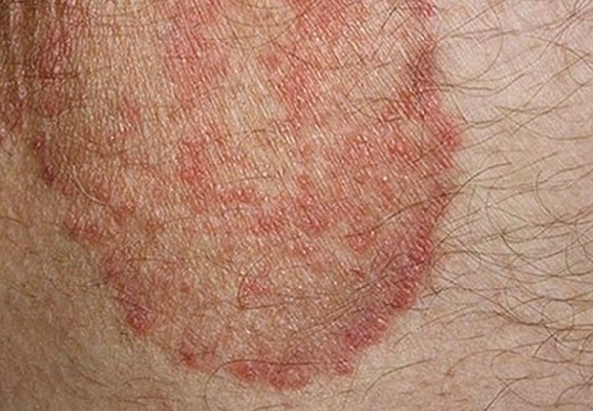 Causes Of Itchy Skin Patches
