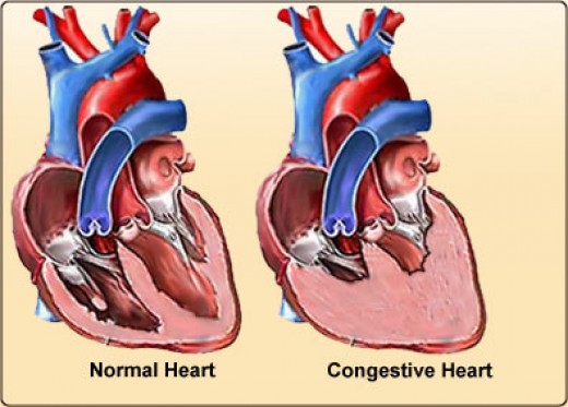 Congestive Heart Failure Basics | hubpages