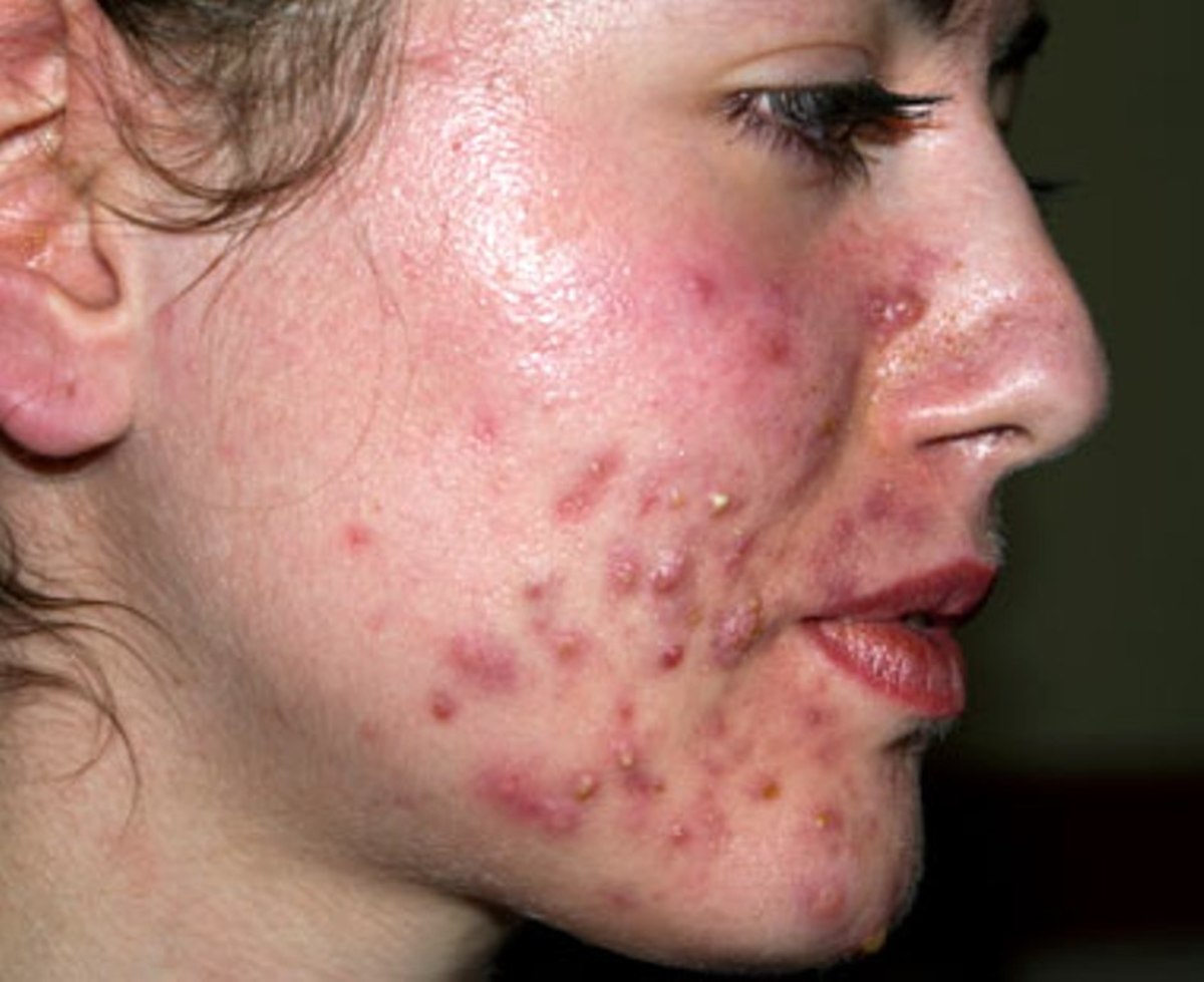 How To Get Rid Of Acne And Its Possible Treatments