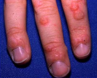 contagious warts spreading from one finger to another