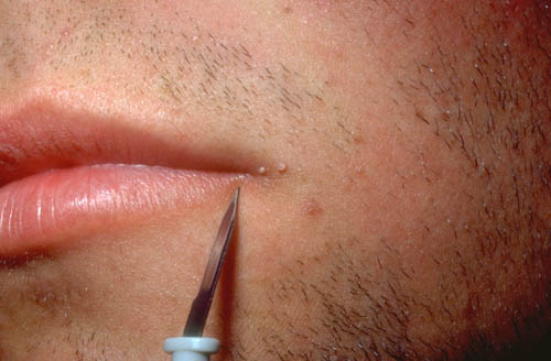 Incision of warts