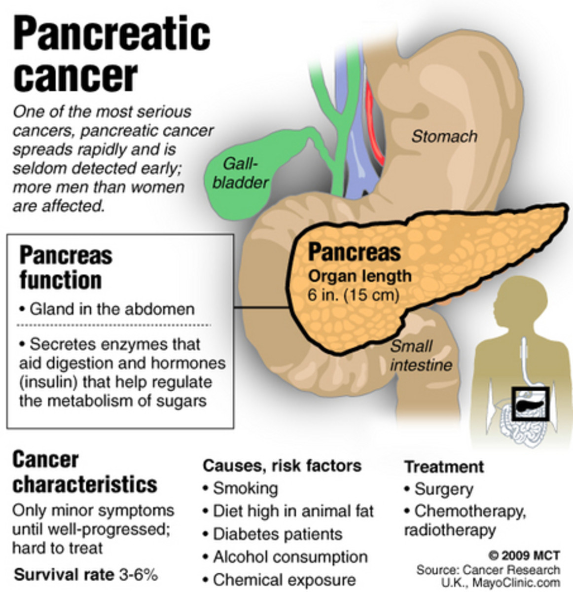 pancreatic cancer is