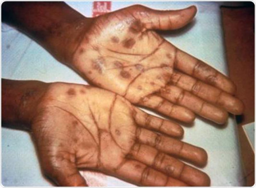 The manifestations of syphilitic cardiovascular disease are seen in the tertiary stage. 
