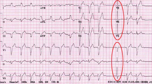 Clincial Complications And Diagnosis Of Acute Myocardial Infarction